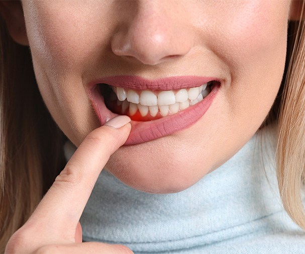 A cropped shot of a young woman revealing her inflamed gums